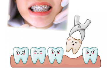 niềng răng có cần phải nhổ răng khôn không?