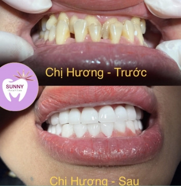 Chị Hương làm thẩm mỹ răng sứ