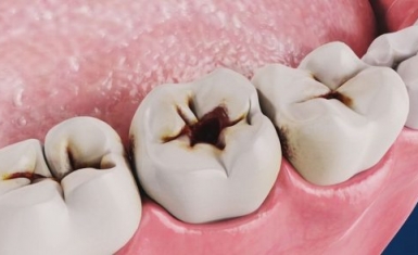 Có nên nhổ răng hàm bị sâu không?